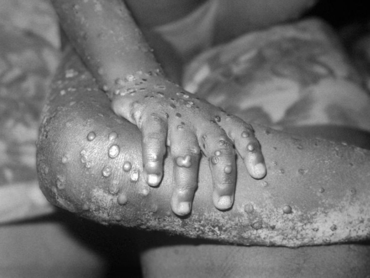 Moçambique/Sociedade: Autoridades confirmam 13 casos de Mpox no distrito de Lago, Niassa, e reforçam medidas de contenção