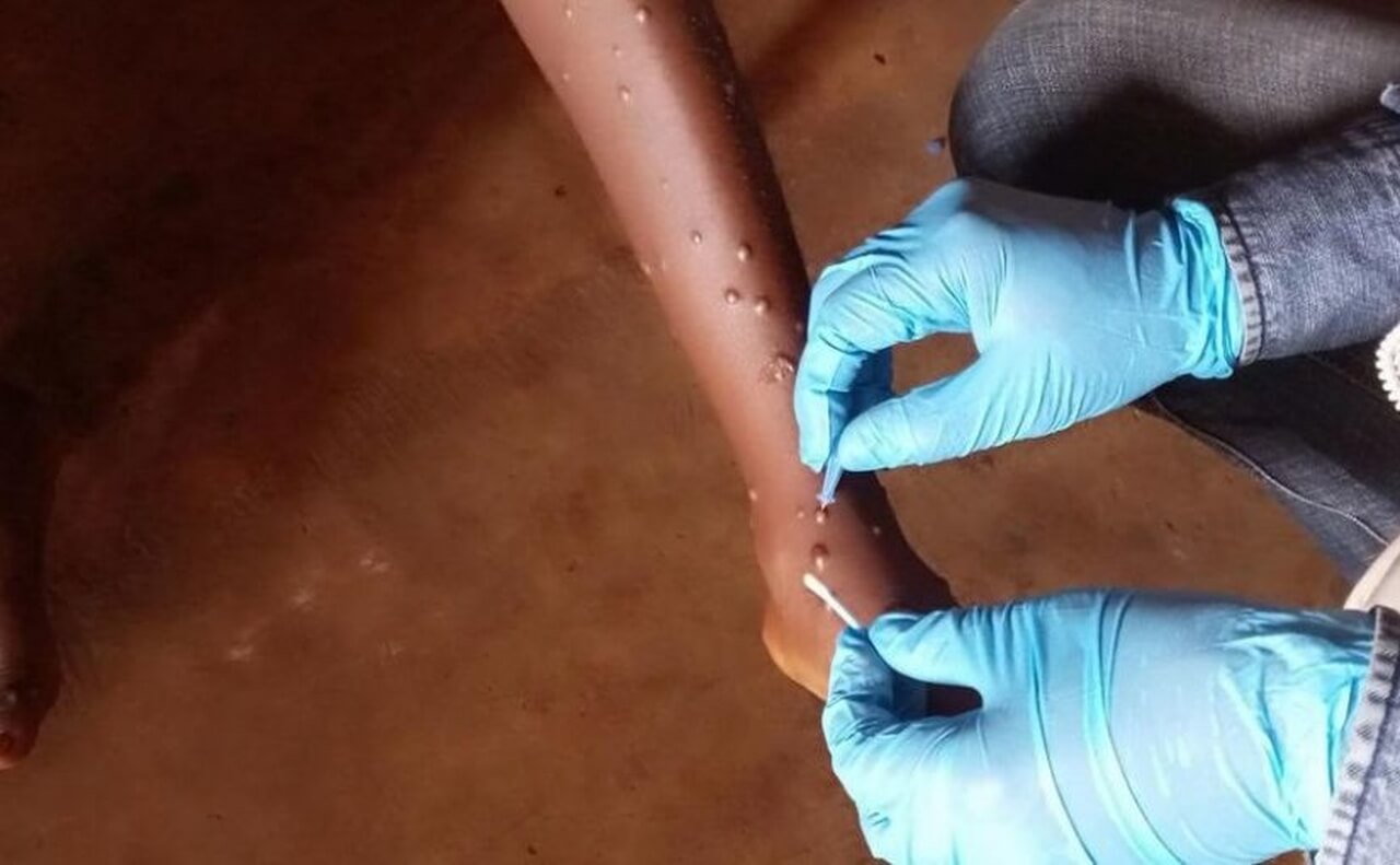 Moçambique/Sociedade: Infetados com mpox em Moçambique sobem para 38 e casos suspeitos para 325
