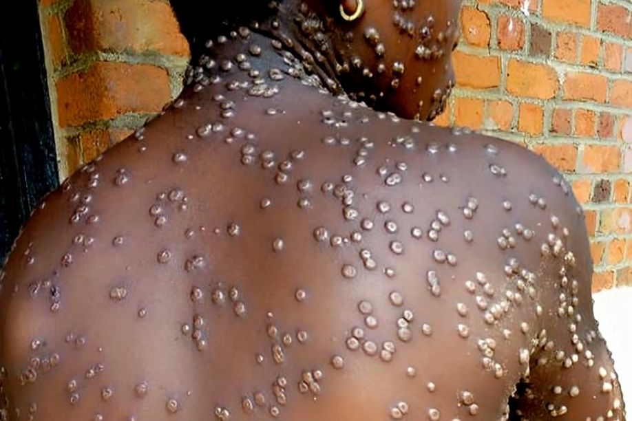 Moçambique/Sociedade:  Primeiro caso de Mpox em Maputo obriga a reforço de medidas de prevenção em todo o país