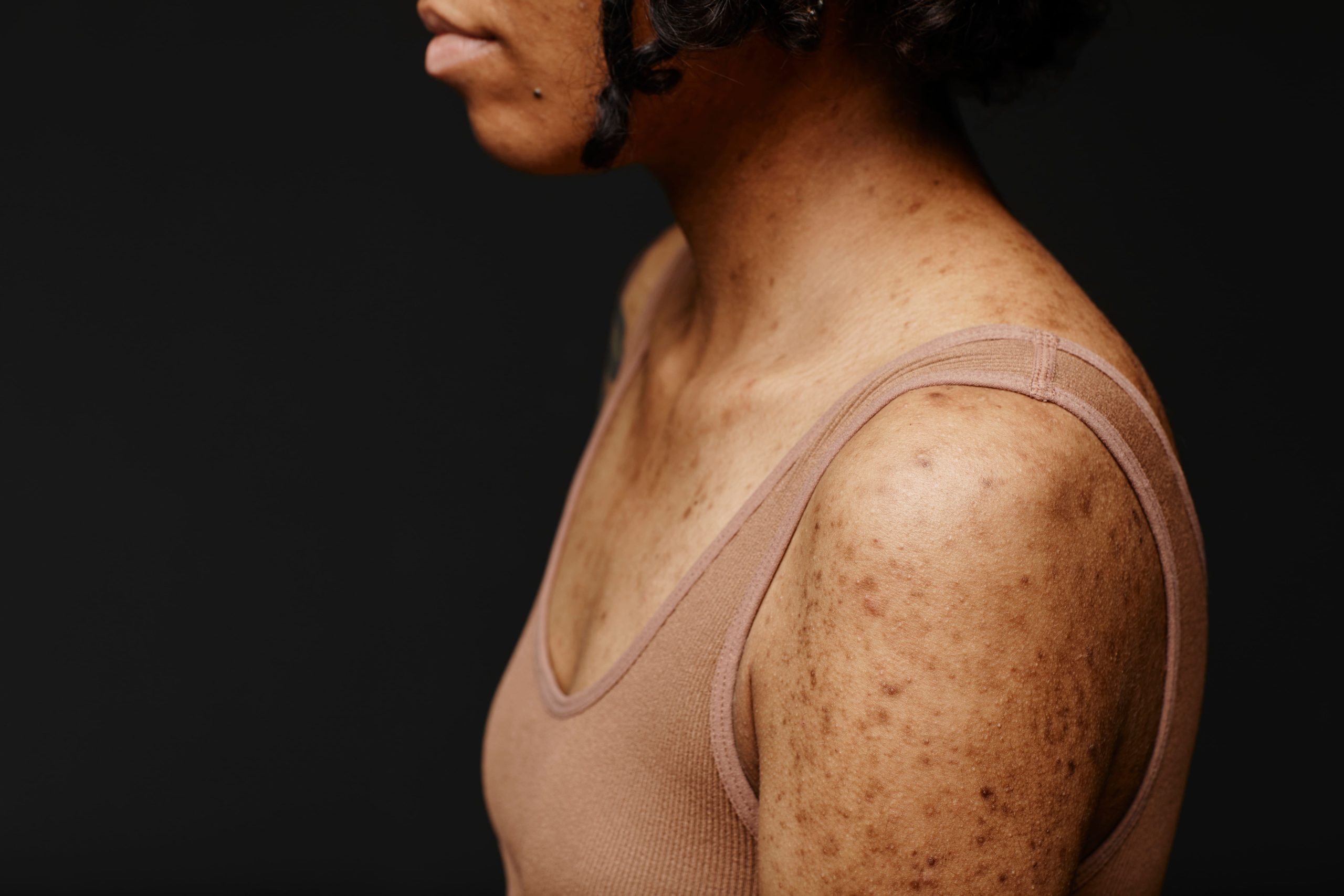 Saúde: Comichões na pele, Quando se torna preocupante?